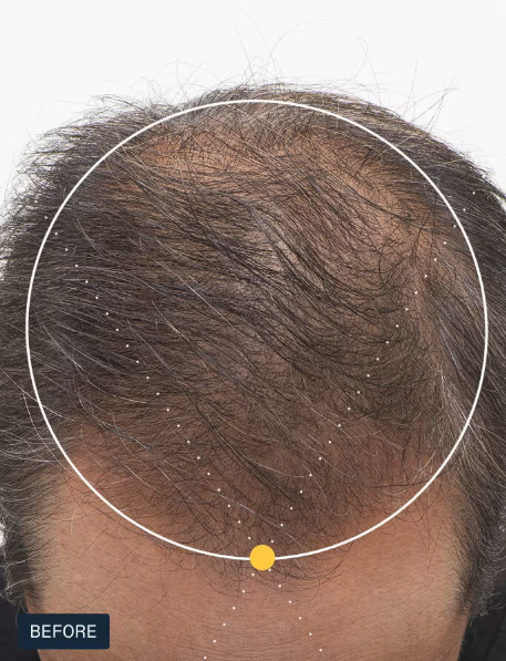 NUTRAFOL- Hair Growth Pack for Men 50+